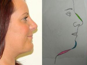 Rhinoplasty Before & After Patient #2674