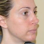 Rhinoplasty Before & After Patient #2673
