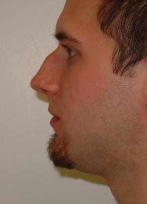 Rhinoplasty Before & After Patient #2671