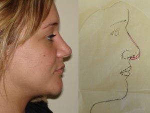 Rhinoplasty Before & After Patient #2670