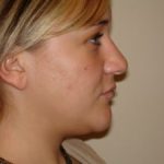 Rhinoplasty Before & After Patient #2670