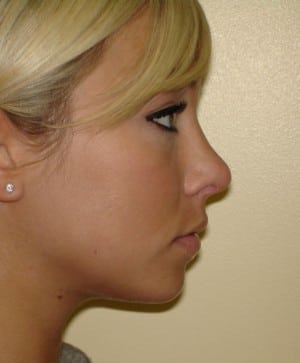 Rhinoplasty Before & After Patient #2669