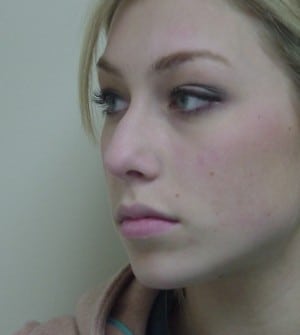 Rhinoplasty Before & After Patient #2669