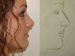 Rhinoplasty Before & After Patient #2668