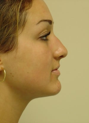 Rhinoplasty Before & After Patient #2668