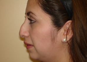 Rhinoplasty Before & After Patient #2667