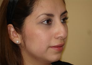 Rhinoplasty Before & After Patient #2667