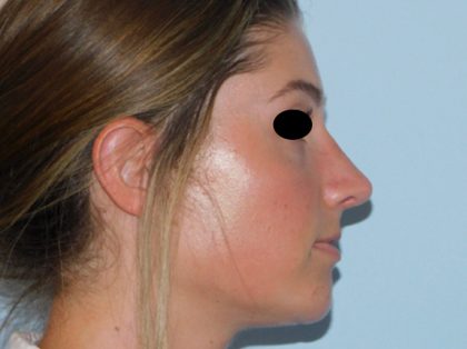 Rhinoplasty Before & After Patient #3057
