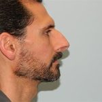 Rhinoplasty Before & After Patient #2663