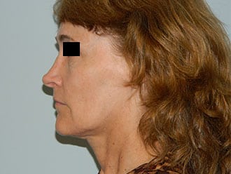 Rhinoplasty Before & After Patient #2661
