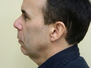 Rhinoplasty Before & After Patient #2660