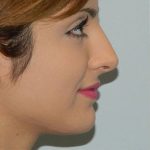 Rhinoplasty Before & After Patient #2659