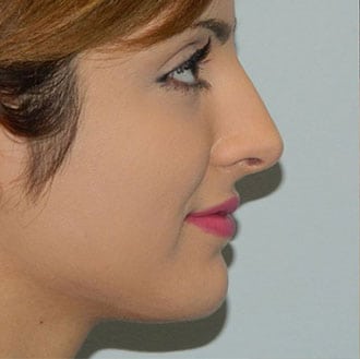 Rhinoplasty Before & After Patient #2659