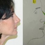 Rhinoplasty Before & After Patient #2658