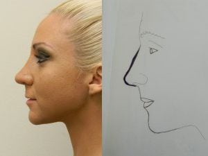 Rhinoplasty Before & After Patient #2657