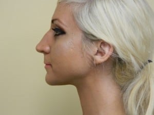 Rhinoplasty Before & After Patient #2657