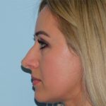 Rhinoplasty Before & After Patient #3056
