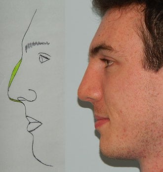 Rhinoplasty Before & After Patient #2656