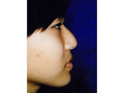 Rhinoplasty Before & After Patient #2653