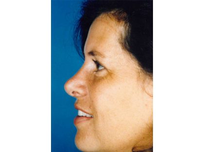 Rhinoplasty Before & After Patient #2652