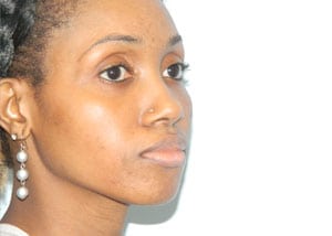 Rhinoplasty Before & After Patient #2648