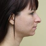 Rhinoplasty Before & After Patient #2646