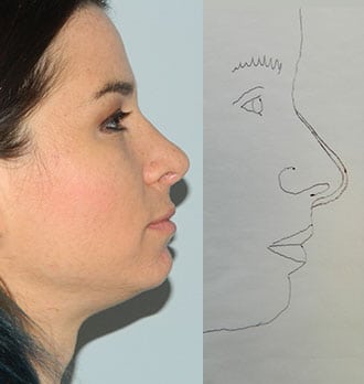 Rhinoplasty Before & After Patient #2646