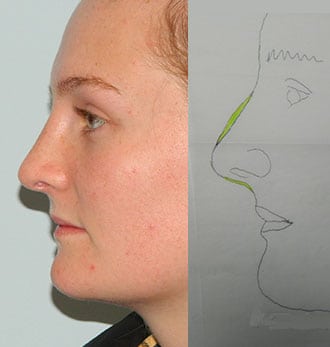 Rhinoplasty Before & After Patient #2645