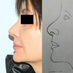 Rhinoplasty Before & After Patient #2644