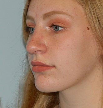 Rhinoplasty Before & After Patient #2642