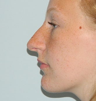 Rhinoplasty Before & After Patient #2642