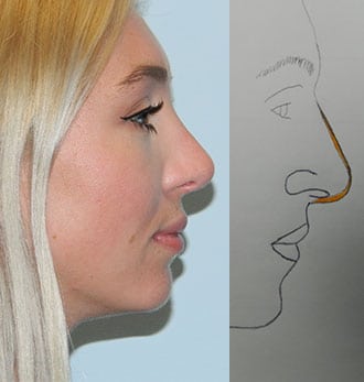 Rhinoplasty Before & After Patient #2641