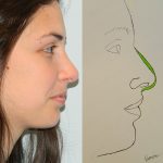 Rhinoplasty Before & After Patient #2640