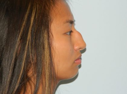 Rhinoplasty Before & After Patient #3053