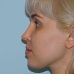 Rhinoplasty Before & After Patient #3052