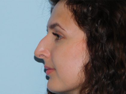 Rhinoplasty Before & After Patient #3050