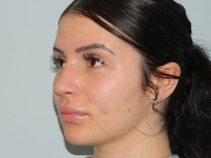 Rhinoplasty Before & After Patient #3049
