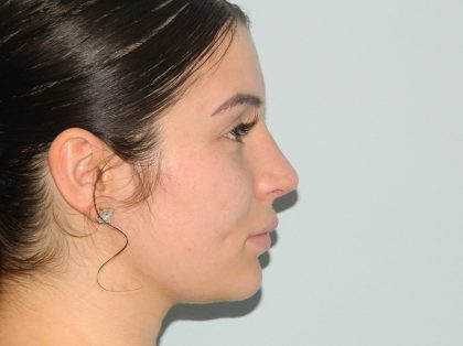 Rhinoplasty Before & After Patient #3049