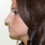Rhinoplasty Before & After Patient #3067