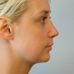 Rhinoplasty Before & After Patient #3048