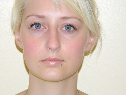 Rhinoplasty Before & After Patient #3048