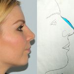 Rhinoplasty Before & After Patient #3045