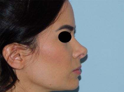 Rhinoplasty Before & After Patient #3044
