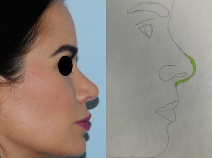 Rhinoplasty Before & After Patient #3044