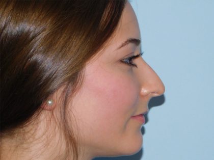 Rhinoplasty Before & After Patient #3043