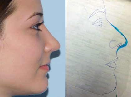 Rhinoplasty Before & After Patient #3043