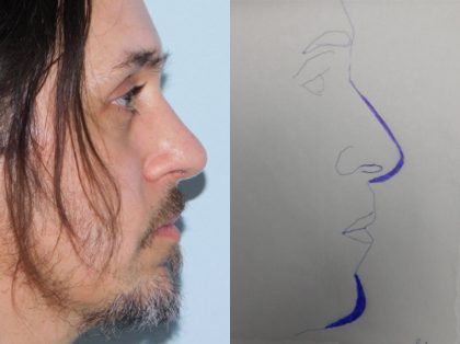 Rhinoplasty Before & After Patient #3039