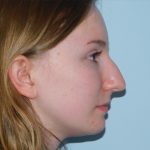 Rhinoplasty Before & After Patient #3038
