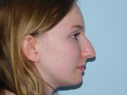 Rhinoplasty Before & After Patient #3038