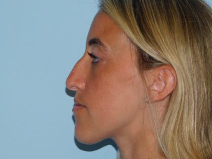 Rhinoplasty Before & After Patient #3037